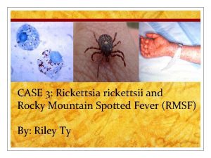 CASE 3 Rickettsia rickettsii and Rocky Mountain Spotted