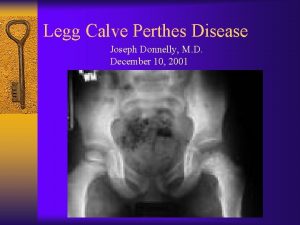 Legg Calve Perthes Disease Joseph Donnelly M D