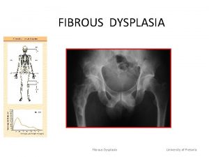 FIBROUS DYSPLASIA Fibrous Dysplasia University of Pretoria DEFINITION