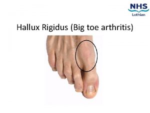 Hallux Rigidus Big toe arthritis Contents 1 2