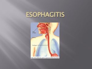 ESOPHAGITIS Esophagitis This is the general term for