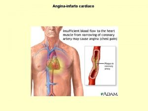 Anginainfarto cardiaco Angina pectoris Laterosclerosi del territorio coronarico