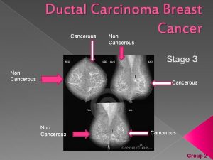 Ductal Carcinoma Breast Cancerous Non Cancerous Stage 3