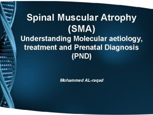 Spinal Muscular Atrophy SMA Understanding Molecular aetiology treatment