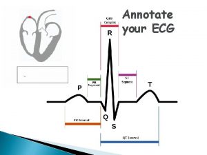 Annotate your ECG Electrocardiogram ECG Electrodes are placed