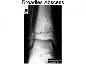 Broadies Abscess Clalcaneal spur Calcaneal Fracture Ankle fracturefibula