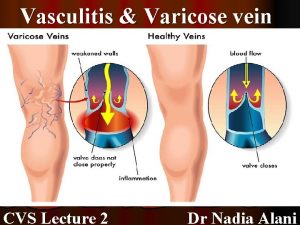 Vasculitis Varicose vein CVS Lecture 2 Dr Nadia