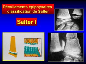 Dcollements piphysaires classification de Salter I Salter II