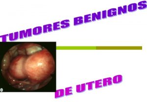 MIOMATOSIS UTERINA p p p p TUMORES BENIGNOS