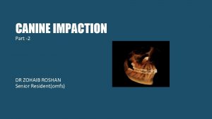 CANINE IMPACTION Part 2 DR ZOHAIB ROSHAN Senior