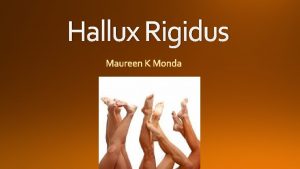 Hallux Rigidus Grade Examination findings Xray findings 0