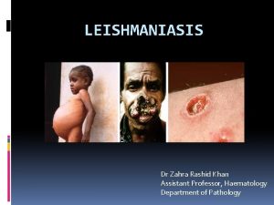 LEISHMANIASIS Dr Zahra Rashid Khan Assistant Professor Haematology