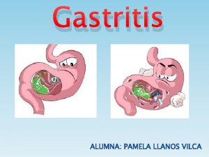 Gastritis Definicin Gastritis es la inflamacin de la