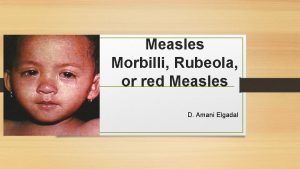 Measles Morbilli Rubeola or red Measles D Amani