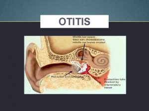 OTITIS PRESENTED BY Alisius Heru Setiawan Nainggolan 14700094