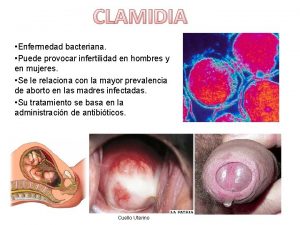 CLAMIDIA Enfermedad bacteriana Puede provocar infertilidad en hombres