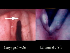 Laryngeal webs Laryngeal cysts Subglottic stenosis signs Discharge