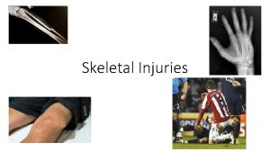 Skeletal Injuries Skeletal InjuriesFracture Fractures fx break in