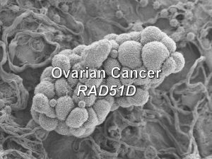 Ovarian Cancer RAD 51 D What is Ovarian
