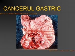 CANCERUL GASTRIC CANCERUL GASTRIC Epidemiologie n Prevalena variaz