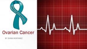 Ovarian Cancer BY DIANA MONTANEZ What is Ovarian