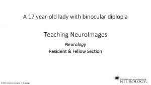 A 17 yearold lady with binocular diplopia Teaching