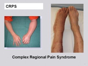 CRPS Complex Regional Pain Syndrome 1 Complex Regional