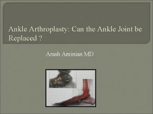 Ankle Arthroplasty Can the Ankle Joint be Replaced