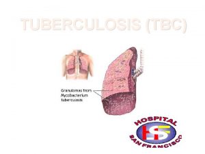 TUBERCULOSIS TBC Es una infeccin bacteriana causada por