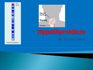Hypothyroidism By Adrian Lewis What is Hypothyriodism Hypothyroidism