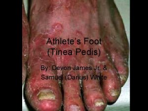 Athletes Foot Tinea Pedis By Devon James Jr